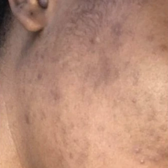 Client result 10 after using KlutchJa Organics products