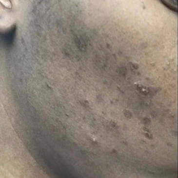 Client result 10 before using KlutchJa Organics products